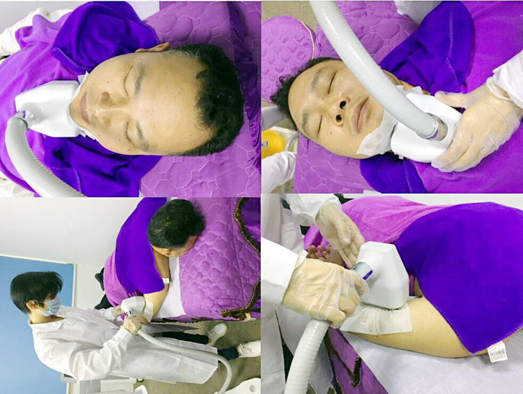 360 degree cryolipolysis treatment 360 degree cryolipolysis treatment
